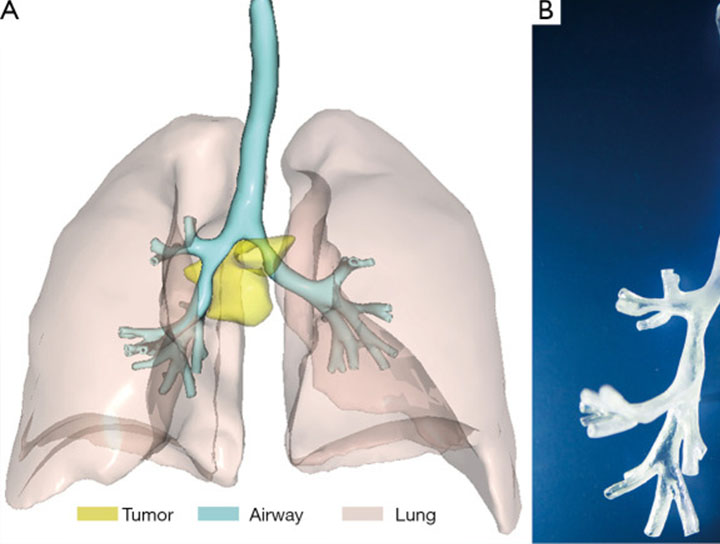 Airway Stent